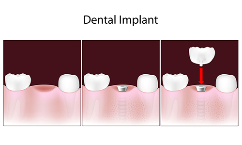 Dental Implants in Annapolis