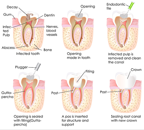 Root Canals in Gaithersburg