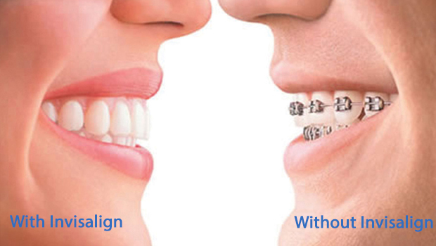 Admiral Heights Invisalign