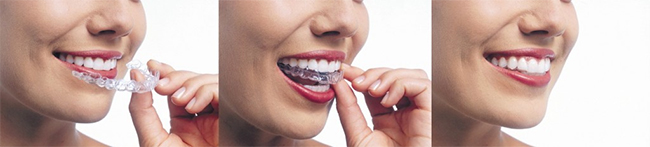 Invisalign in Annapolis